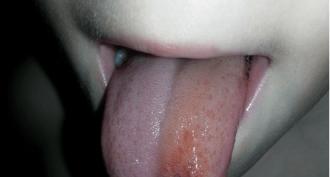 I bit my tongue, an ulcer formed, how to treat
